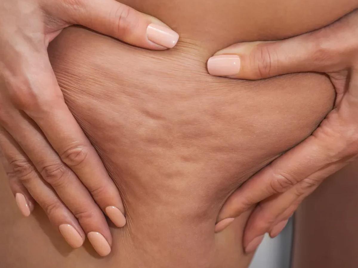 Come restare attivi con il lipedema senza peggiorare i sintomi